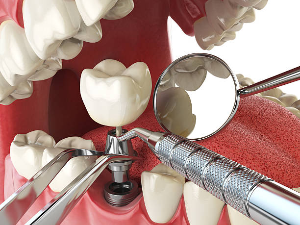 Best Emergency Wisdom Tooth Extraction in St Paul Park, MN
